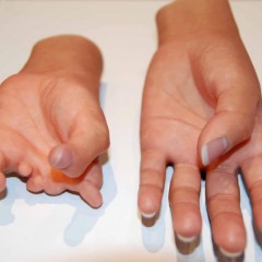 PROTEZA PARTIALA DE MANA ESTETICA - LIVINGSKIN