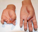 PROTEZA PARTIALA DE MANA ESTETICA - LIVINGSKIN