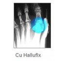 Orteza pentru hallux-valgus - Hallufix